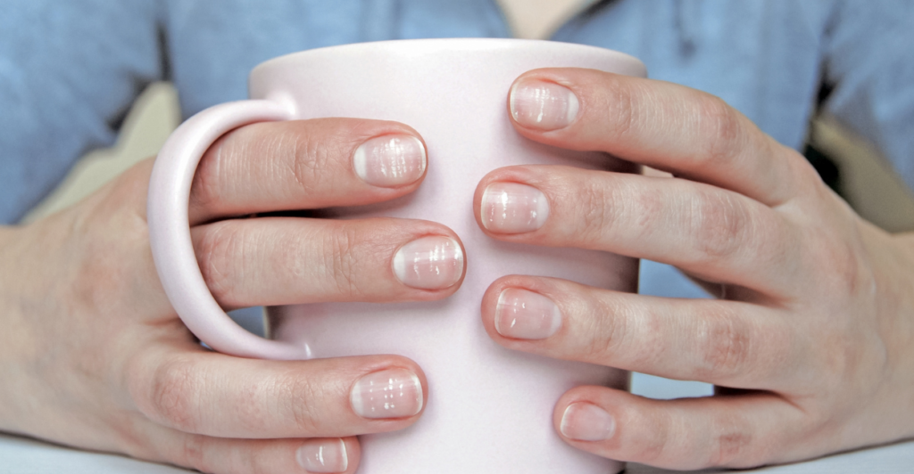 Manchas Brancas nas Unhas: O Que Elas Significam e Como Tratar